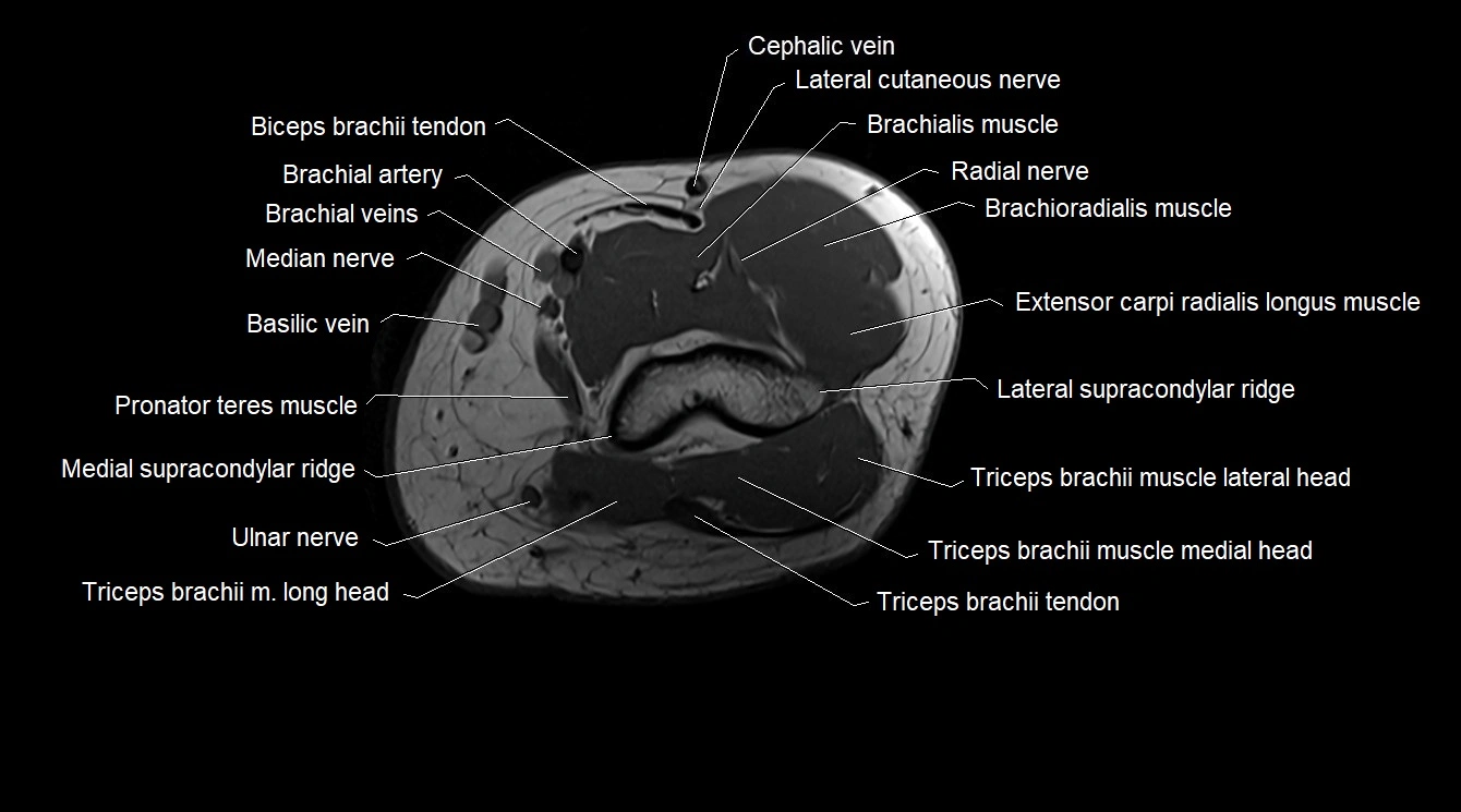 Upper arm( humerus) cross section anatomy MRI 3T axial image 51.webp
